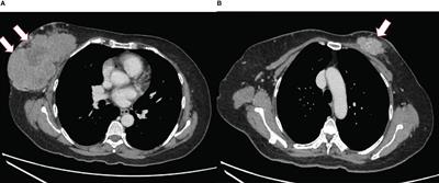 Bilateral metachronous breast malignancies: Malignant phylloides and invasive breast carcinoma—a case report